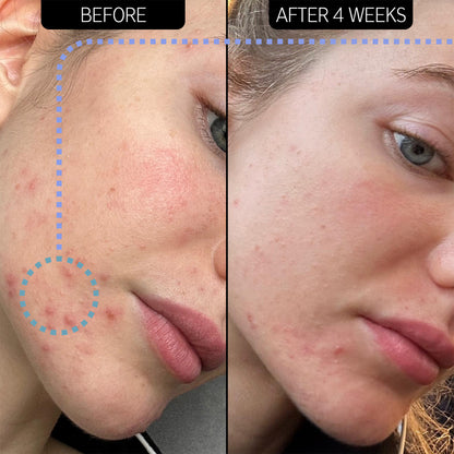 Side-by-side comparison showing facial skin before and after 4 weeks of skincare use. The "before" image displays visible acne, redness, and blemishes on the cheek and chin area, while the "after" image shows a clearer complexion with reduced redness, fewer breakouts, and improved skin texture.