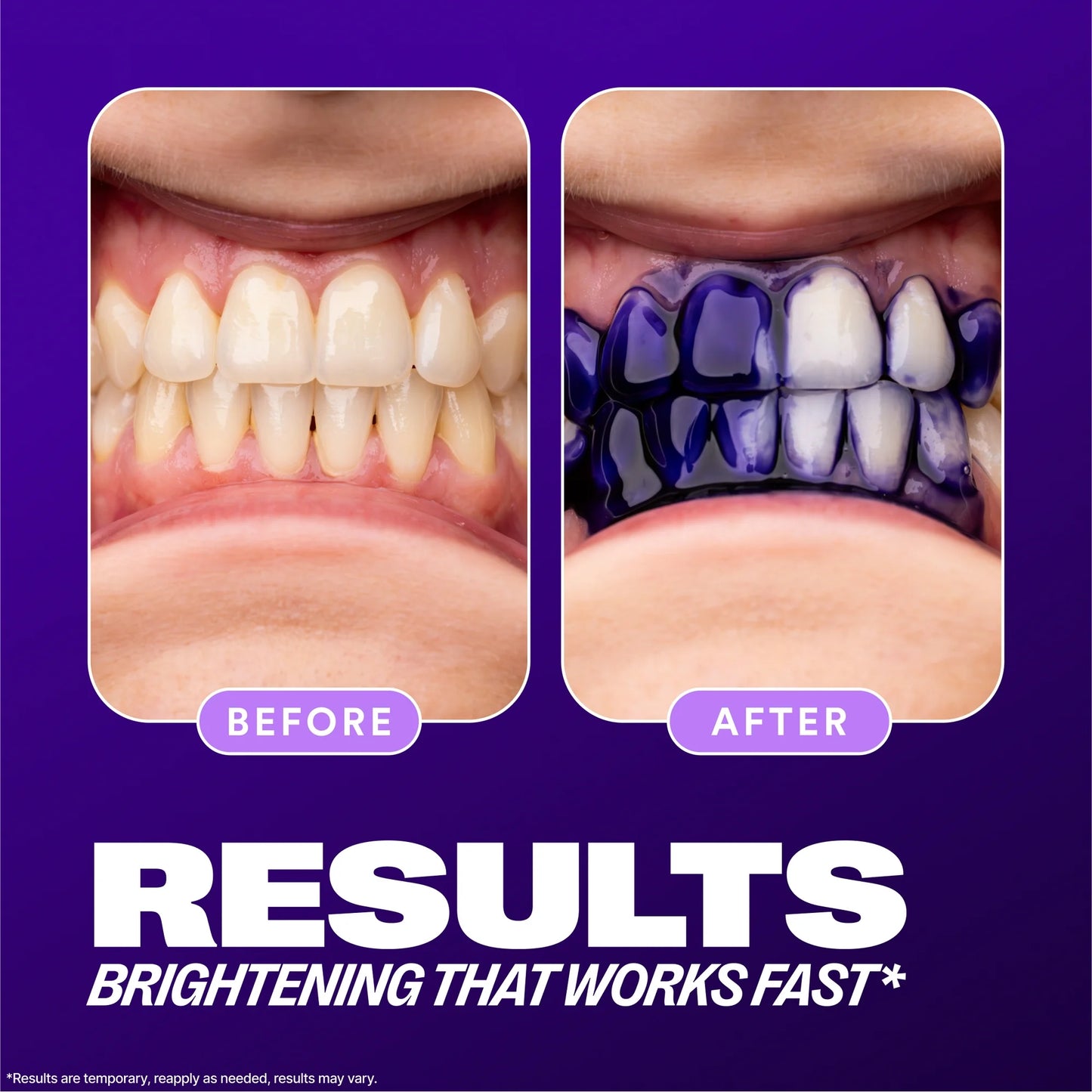 Before and after showing teeth whitening results with a purple background.