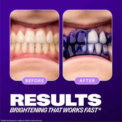 Before and after showing teeth whitening results with a purple background.