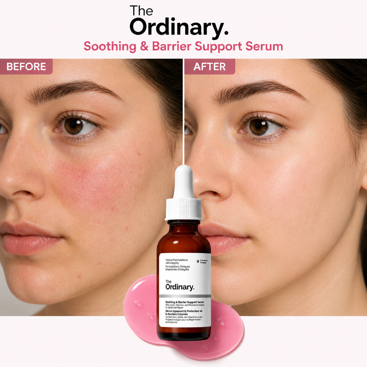 Before-and-after comparison featuring The Ordinary Soothing & Barrier Support Serum. The image shows visible reduction in facial redness and irritation, with calmer, more even-toned skin after use. Product bottle displayed in the center with pink serum texture, highlighting skin barrier repair and hydration benefits. 