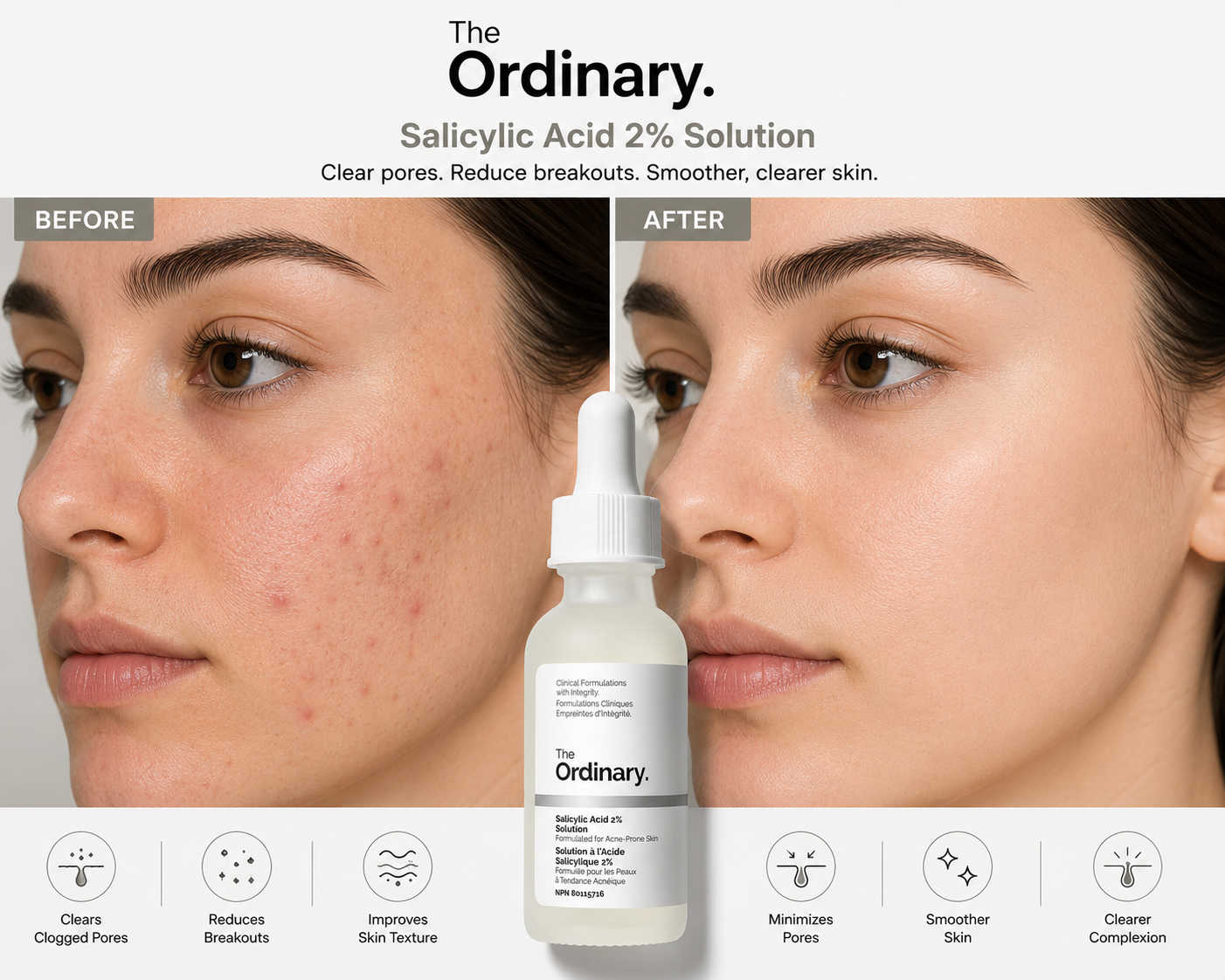 Before-and-after comparison showing skin improvement with The Ordinary Salicylic Acid 2% Solution. The image highlights reduced breakouts, minimized pores, smoother skin texture, and a clearer complexion after consistent use of the acne-fighting serum.