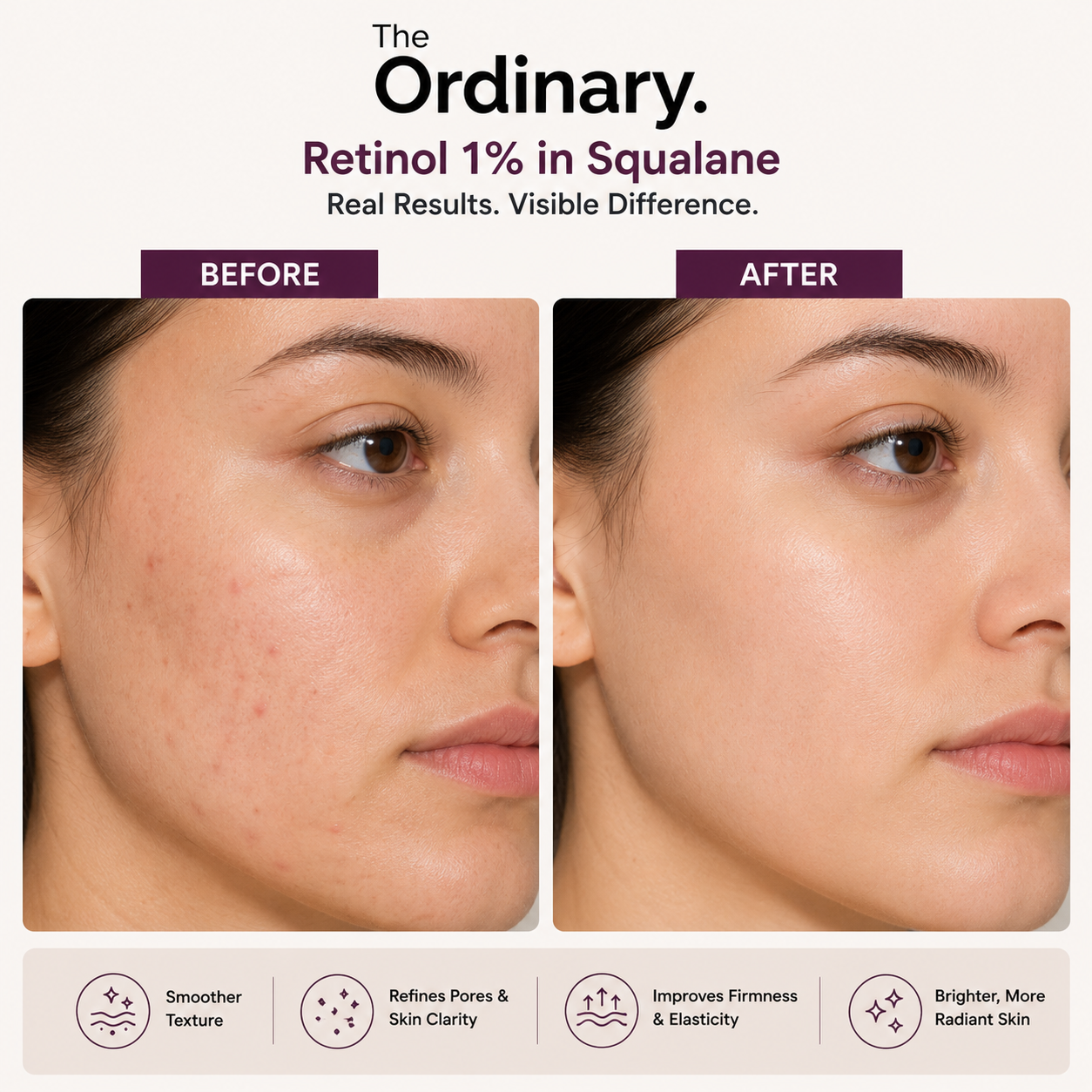 Before-and-after comparison image showcasing The Ordinary Retinol 1% in Squalane serum. The image highlights visible improvements in skin texture, clarity, pore appearance, firmness, and radiance, with smoother and more even-looking skin shown after consistent use. 