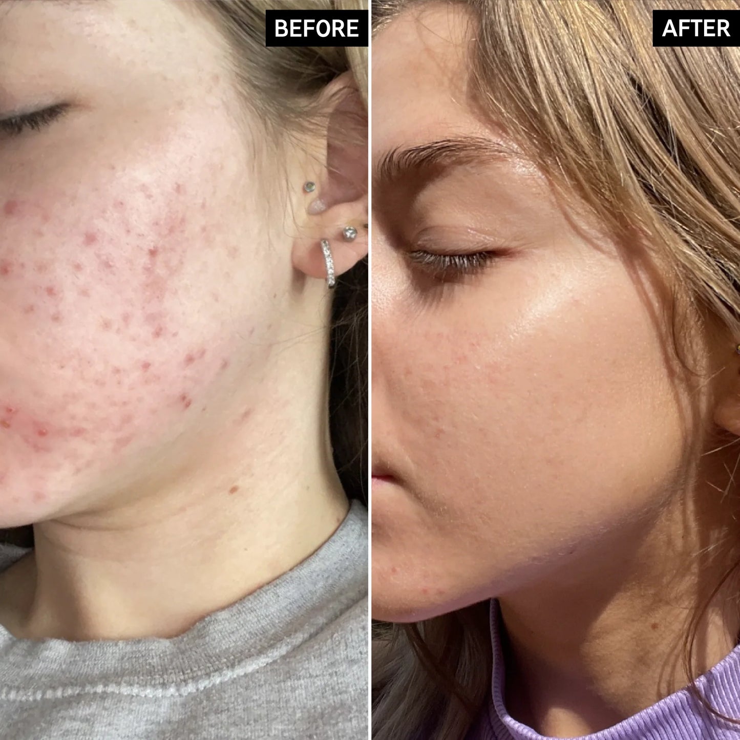 Before and after comparison of a person's face with acne on the left and clear skin on the right.