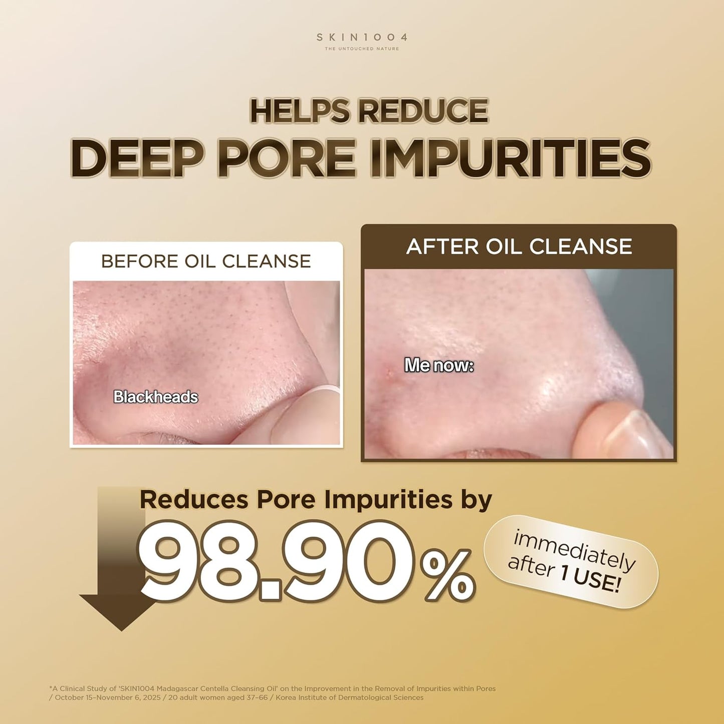 Before-and-after comparison showing the effectiveness of SKIN1004 Madagascar Centella Light Cleansing Oil in reducing deep pore impurities and blackheads. The image highlights visible pore cleansing results after one use, demonstrating smoother-looking skin and cleaner pores. Korean cleansing oil designed for deep pore care, makeup removal, blackhead reduction, and gentle daily cleansing.
