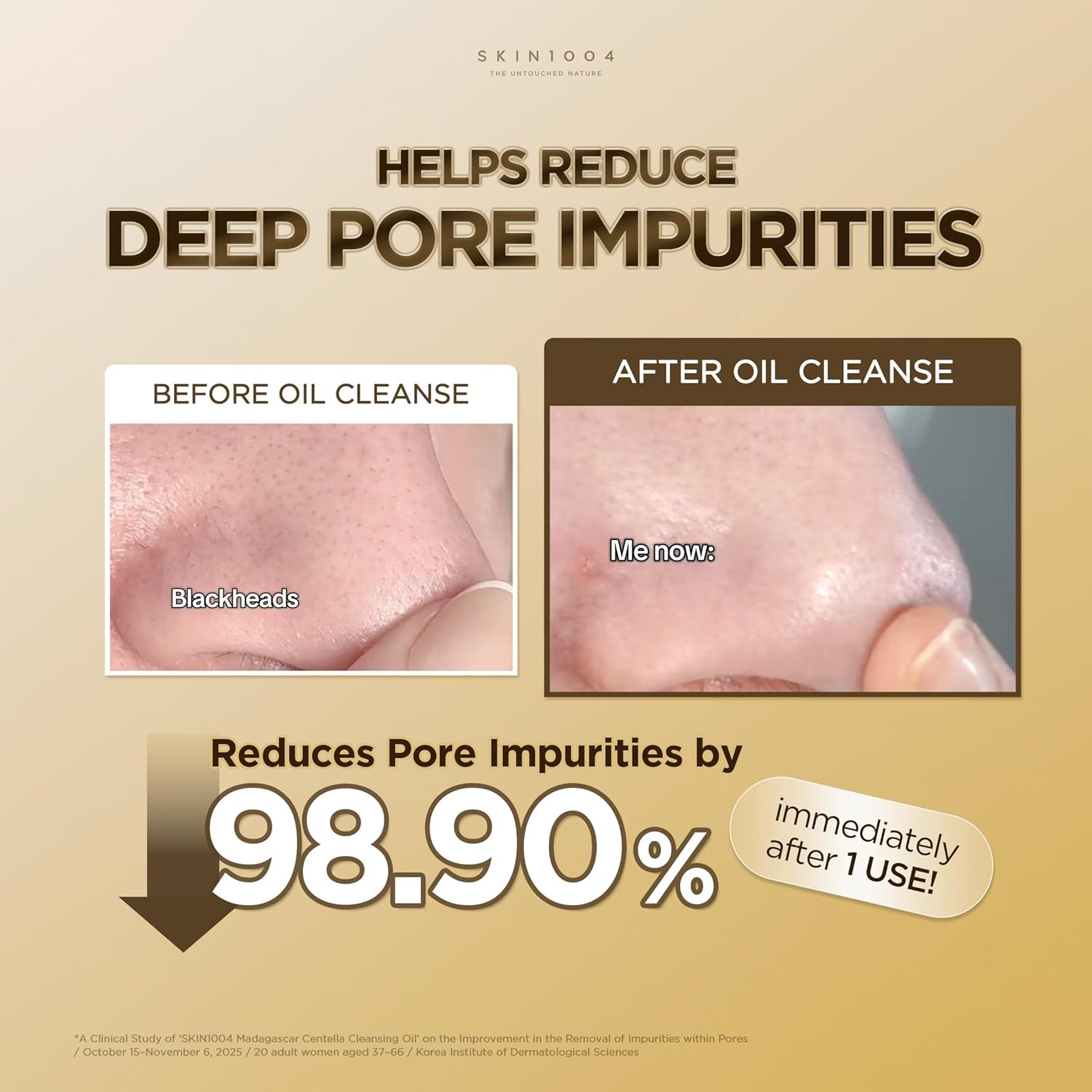 Before-and-after comparison showing the effectiveness of SKIN1004 Madagascar Centella Light Cleansing Oil in reducing deep pore impurities and blackheads. The image highlights visible pore cleansing results after one use, demonstrating smoother-looking skin and cleaner pores. Korean cleansing oil designed for deep pore care, makeup removal, blackhead reduction, and gentle daily cleansing.