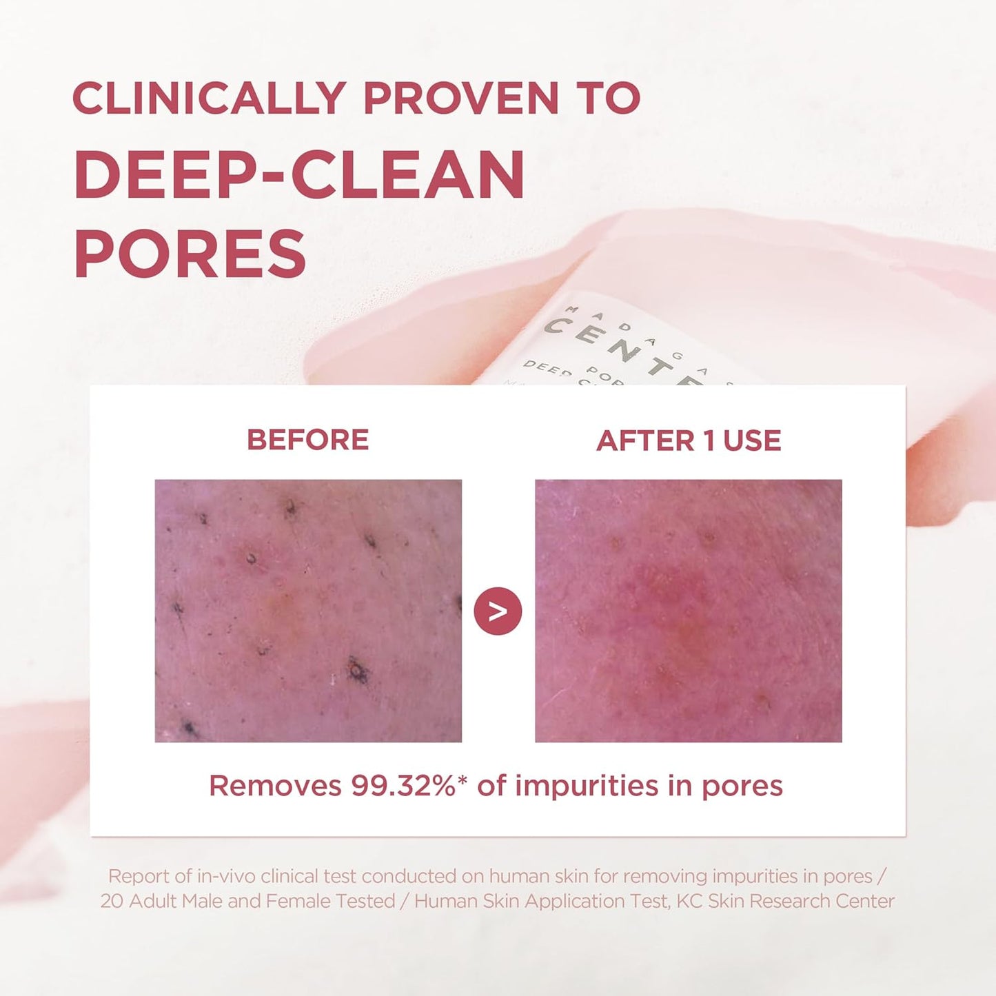Clinical test results image for SKIN1004 Madagascar Centella Poremizing Deep Cleansing Foam showing before-and-after pore cleansing effectiveness. The comparison demonstrates visible removal of pore impurities after one use, with claims of removing 99.32% of impurities from pores. Highlights the cleanser’s deep-cleansing action with Himalayan Pink Salt and Centella Asiatica for clearer, smoother, and purified skin.