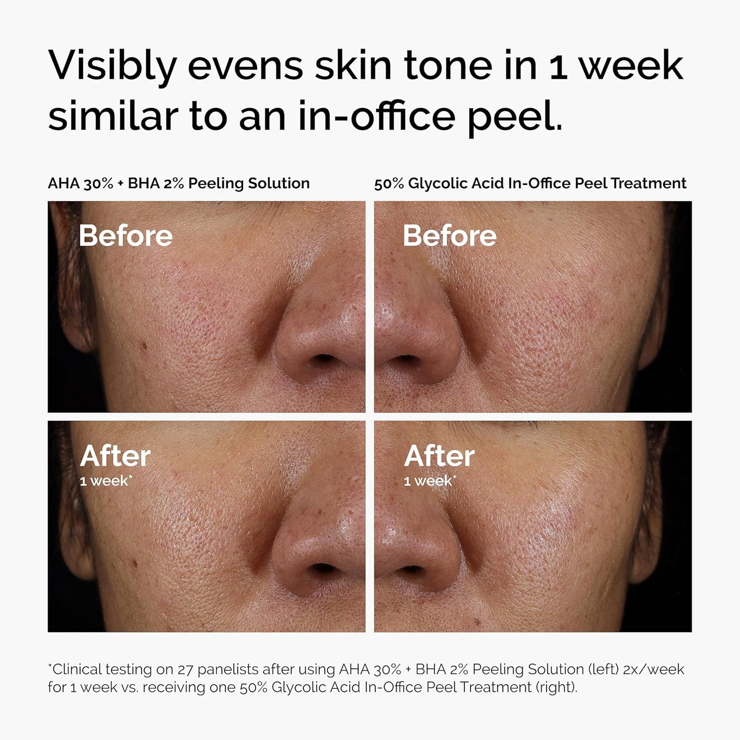 Before and after comparison showing visible skin improvement after using The Ordinary AHA 30% + BHA 2% Peeling Solution for one week. Demonstrates smoother texture, more even skin tone, refined pores, and brighter-looking skin, with results compared to an in-office glycolic acid peel treatment.