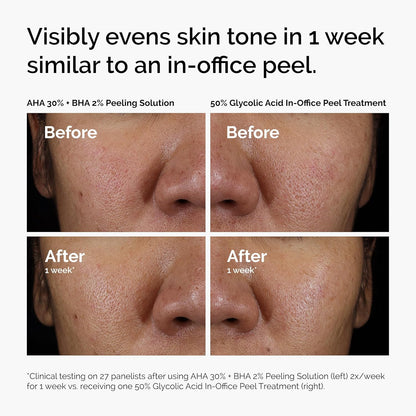 Before and after comparison showing visible skin improvement after using The Ordinary AHA 30% + BHA 2% Peeling Solution for one week. Demonstrates smoother texture, more even skin tone, refined pores, and brighter-looking skin, with results compared to an in-office glycolic acid peel treatment.