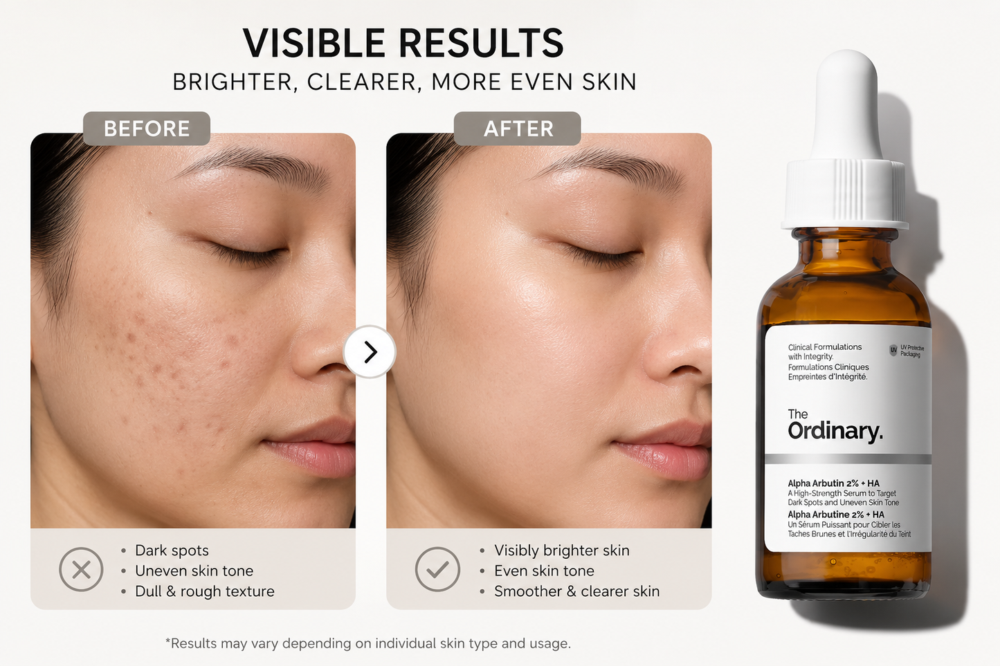 Before and after comparison showing the visible results of The Ordinary Alpha Arbutin 2% + Hyaluronic Acid serum. The image highlights reduced dark spots, a more even skin tone, brighter complexion, and smoother-looking skin, with the product bottle displayed alongside the transformation.