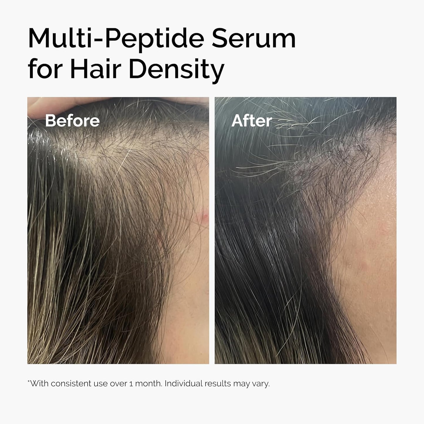 Before and after results of The Ordinary Multi-Peptide Serum for Hair Density showing visibly thicker, fuller-looking hair and improved hair density after consistent use.