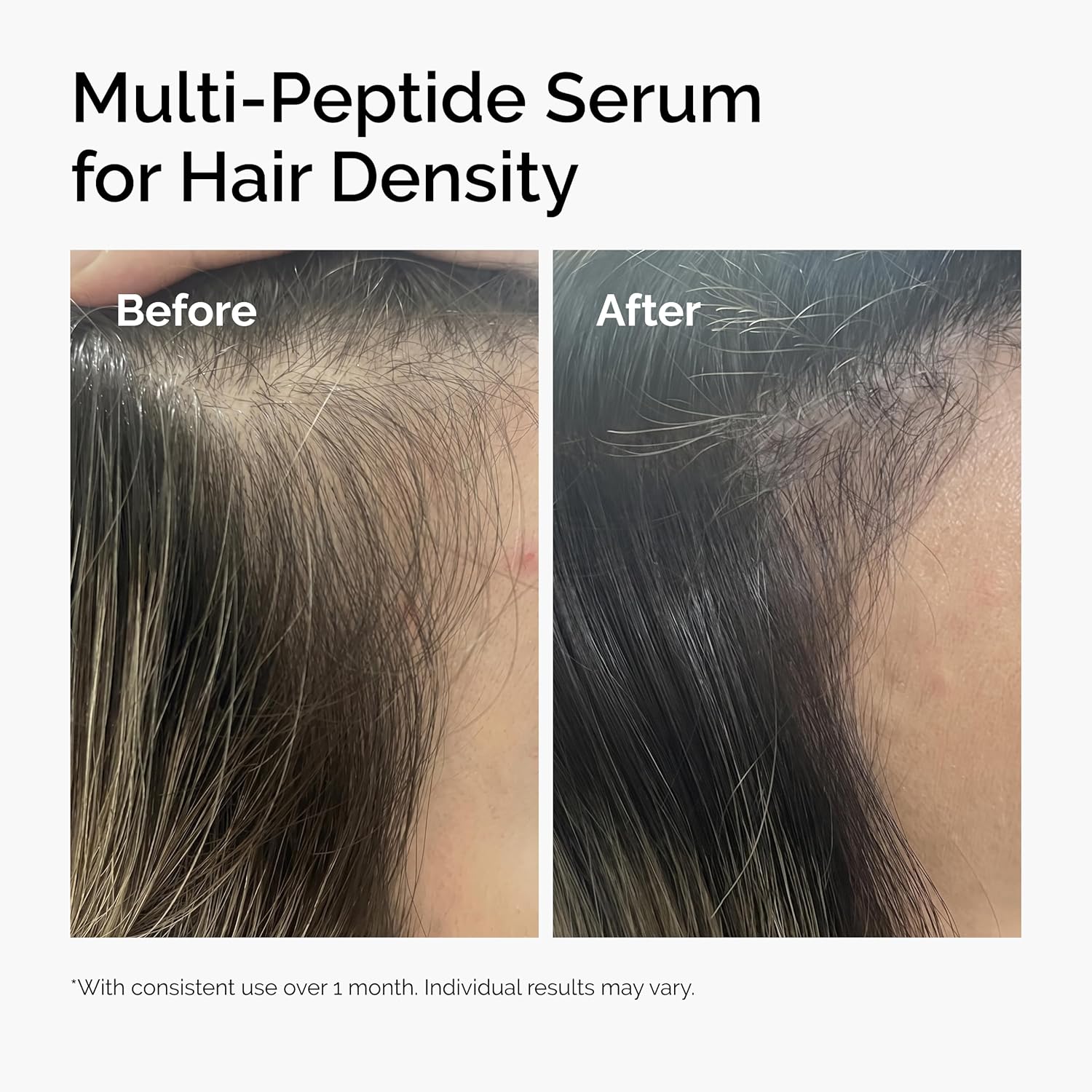 Before and after results of The Ordinary Multi-Peptide Serum for Hair Density showing visibly thicker, fuller-looking hair and improved hair density after consistent use.