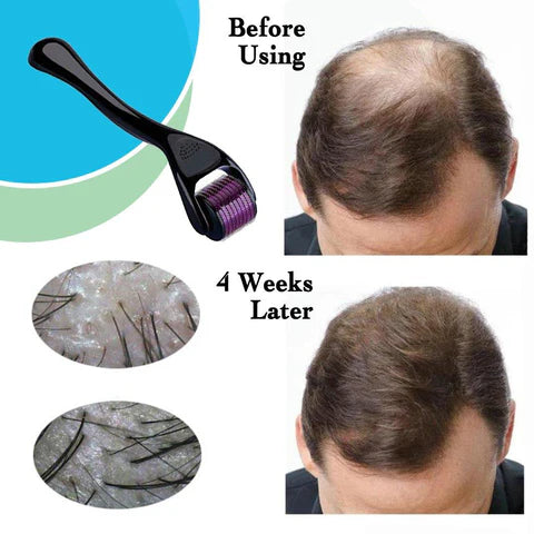 Before and after comparison of hair growth using a roller device, showing results 4 weeks later.